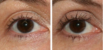 Latisse Before & After