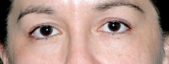 Latisse for Eyelashes