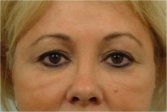 Upper and Lower Blepharoplasty