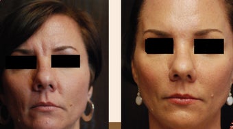 Liquid Facelift using Botox and Dermal Fillers