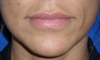 Lip Augmentation
