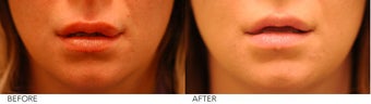 Lip Reduction