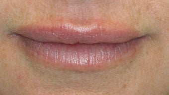Lip Augmentation