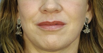 Lip Augmentation with fillers