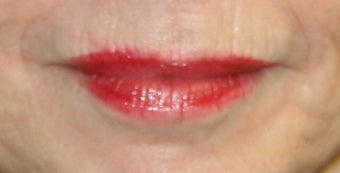 lip filler