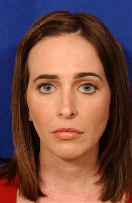 Lip Augmentation with LiveFill to upper-lower lips.