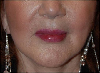 Lip augmentation with Restylane injections