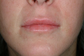 Lip enhancement