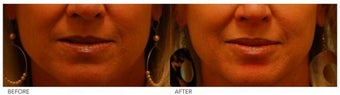 Silicone Lip Enhancement/Augmentation