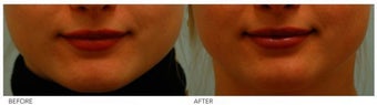 Silicone Lip Enhancement/Augmentation