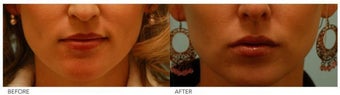 Silicone Lip Enhancement/Augmentation
