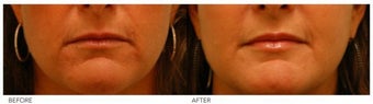 Silicone Lip Enhancement/Augmentation