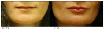 Silicone Lip Enhancement/Augmentation