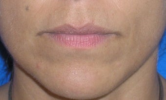 Lip Augmentation