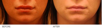 Lip Reduction