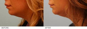 Lip Reduction