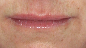 Lip Augmentation