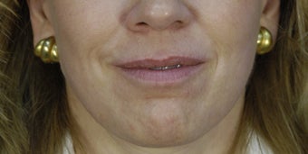 Lip Augmentation with fillers