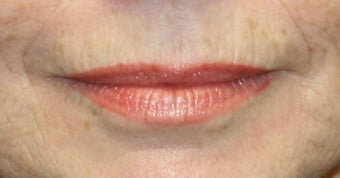 lip filler