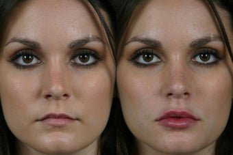 Juvederm Ultra Plus
