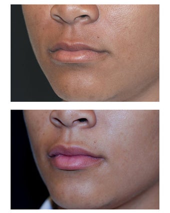 Injectable Filler