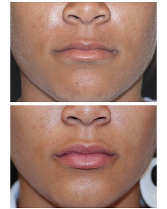 Injectable Filler