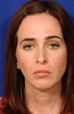 Lip Augmentation with LiveFill to upper-lower lips.