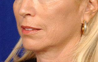 Beforeand After Lip Augmentation