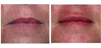 Lip Augmentation with Restylane