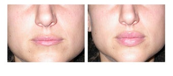 Lip Augmentation