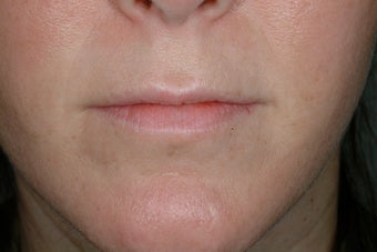 Lip enhancement