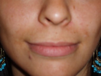 Lip Augmentations