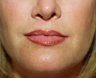 Lip lift, corner of lip lift, and filler in lips