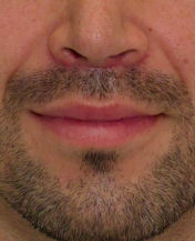 Lip Lift 