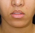 Lip Lift