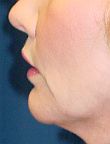 Lip Augmentation with lip lift