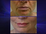 Lip Lift