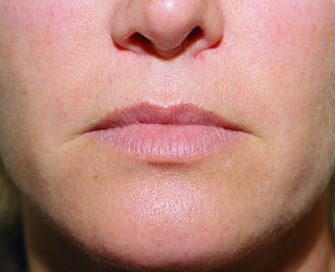 Lip lift, corner of lip lift, and filler in lips
