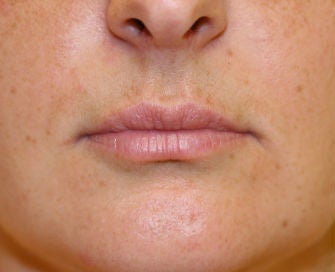 Modified lip lift
