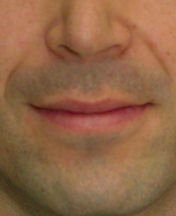 Lip Lift 