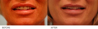 Lip reduction