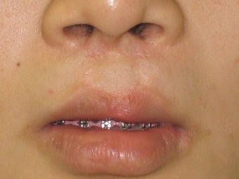 fati injection from abdomen to lip; dermabrasion to nostril scars
