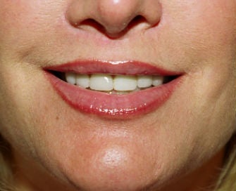 Lip lift, corner of lip lift, and filler in lips