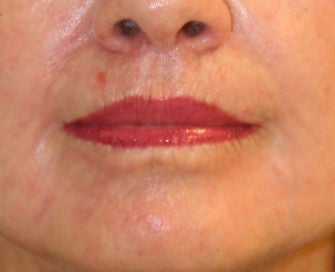 Lip lift, corner of lip lift, and laser treatment of wrinkles around lips