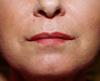 Anguloplasty
