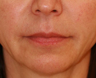 Anguloplasty