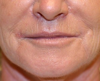 Lip lift, corner of lip lift