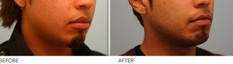 Upper and Lower Lip Reduction