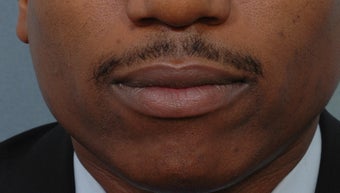 Cheiloplasty
