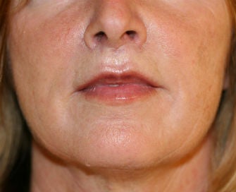 Lip Lift